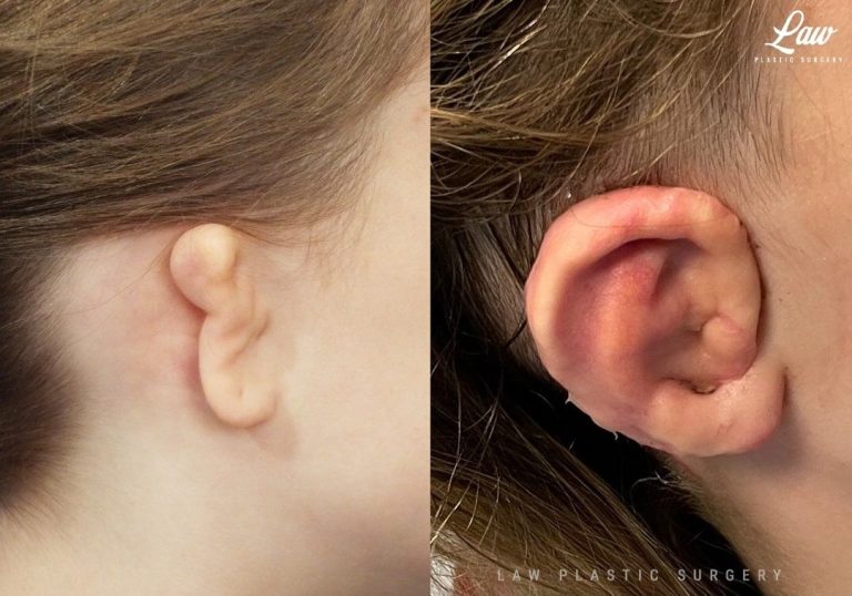 Ear Reconstruction Surgery: Restoring appearance and function