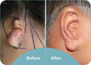ear reconstruction surgery ear reconstruction surgery