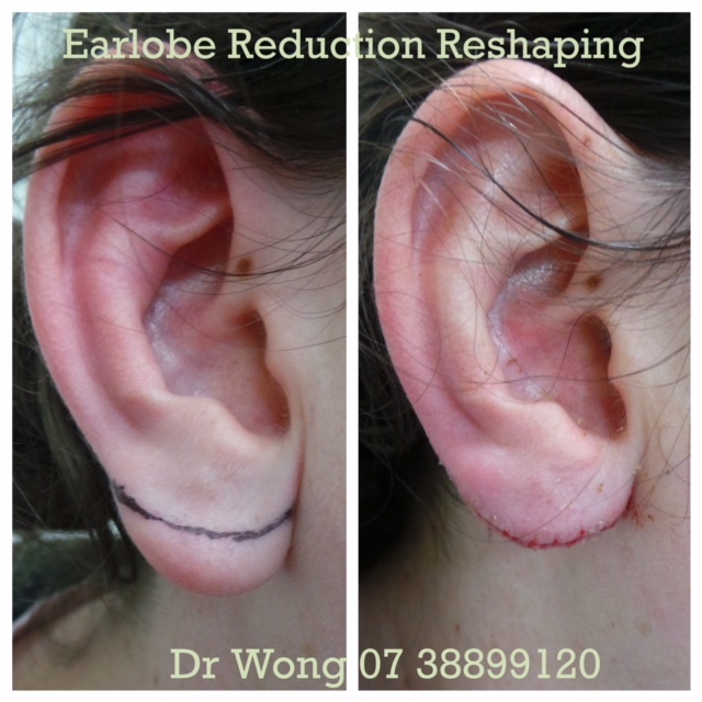 earlobe reduction earlobe reduction
