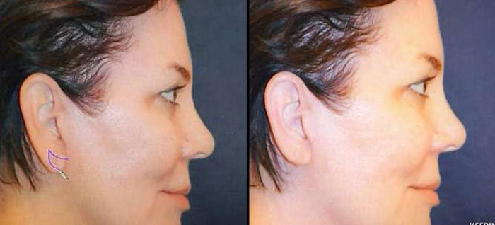 earlobe reduction earlobe reduction