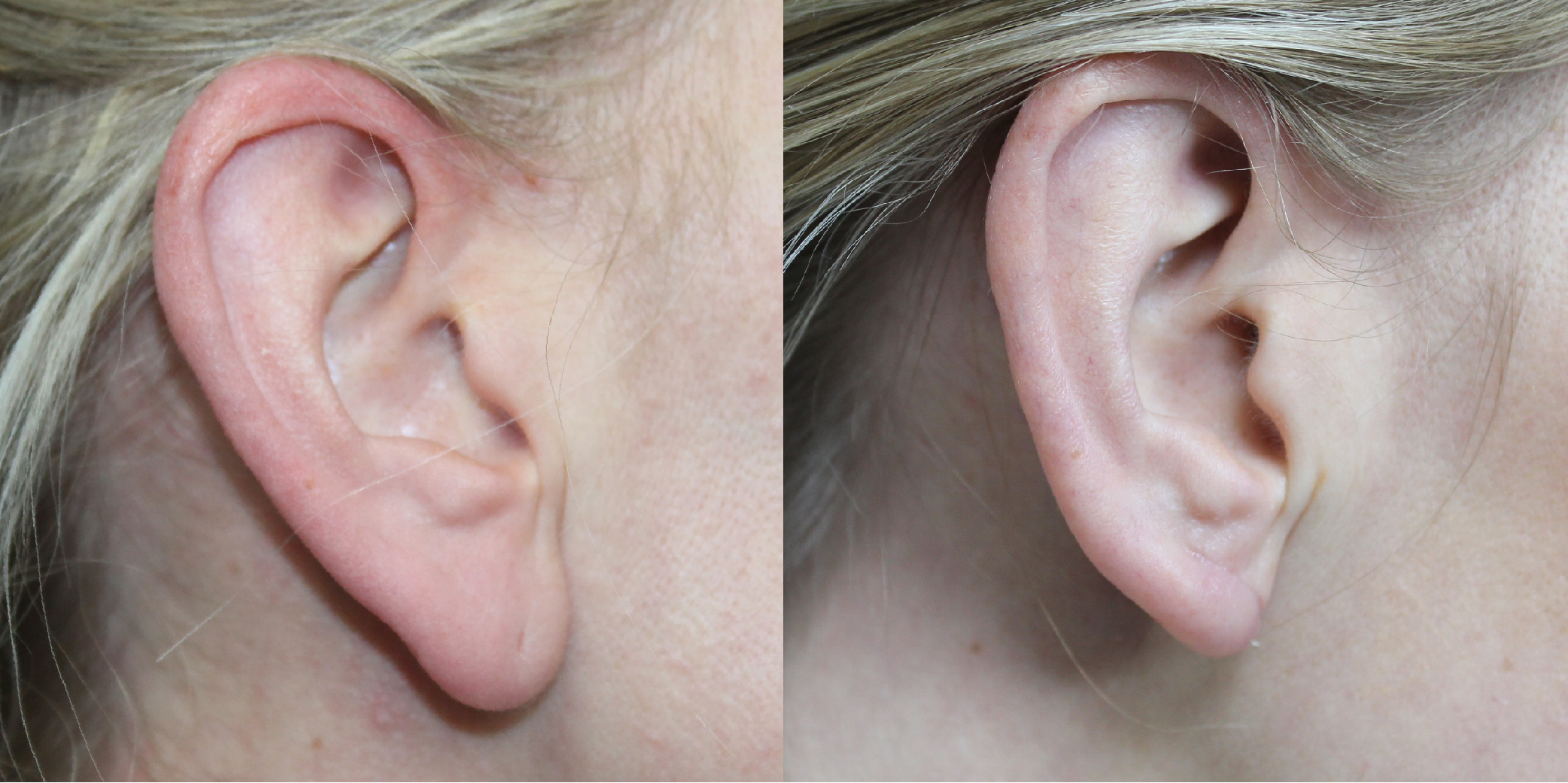 earlobe reduction earlobe reduction