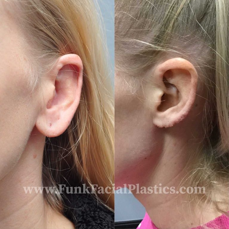Earlobe reduction: Subtle changes for enhanced ear aesthetics