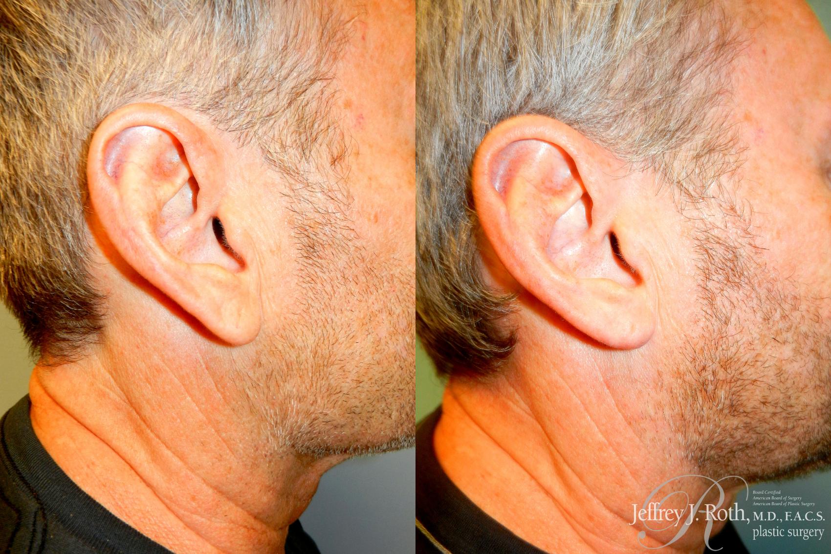 earlobe reduction earlobe reduction
