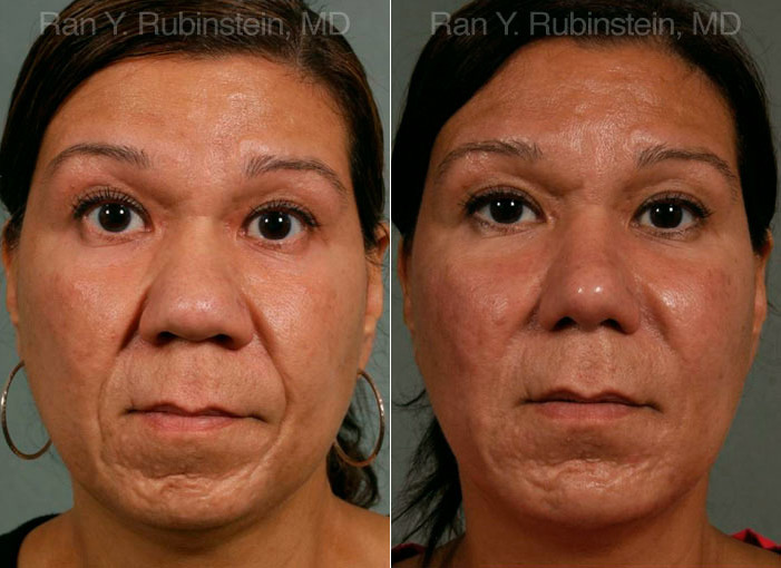 ethnic rhinoplasty ethnic rhinoplasty