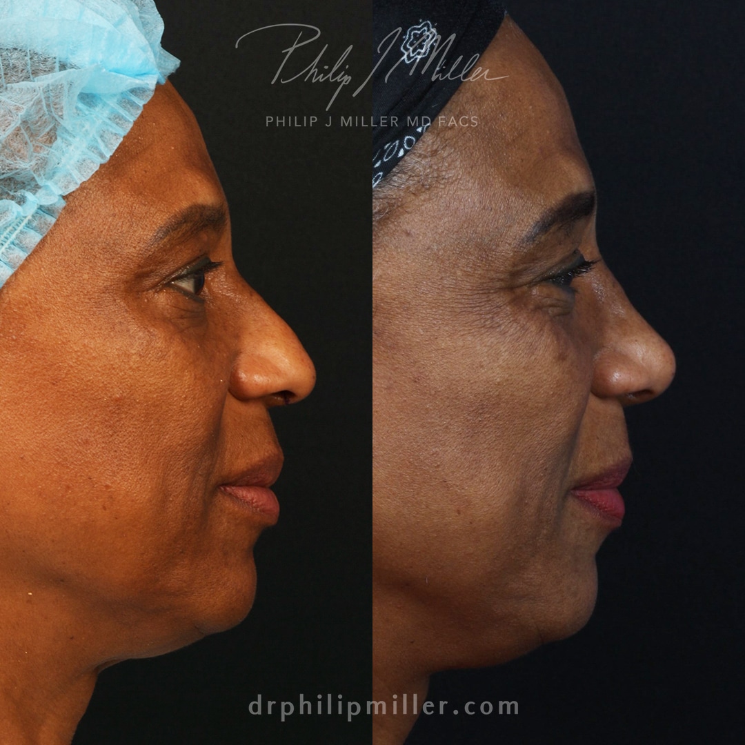 ethnic rhinoplasty ethnic rhinoplasty