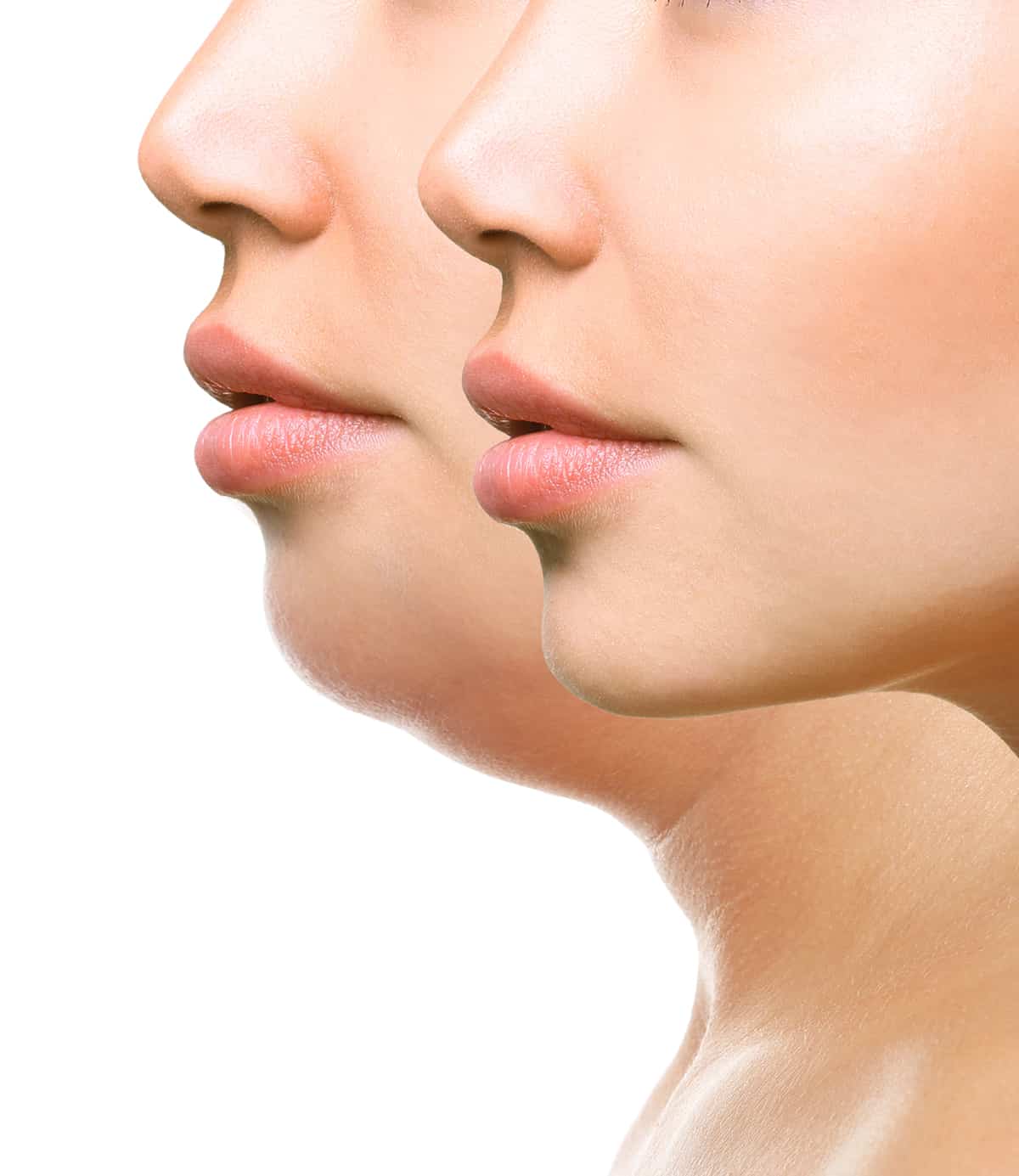 submental liposuction submental liposuction