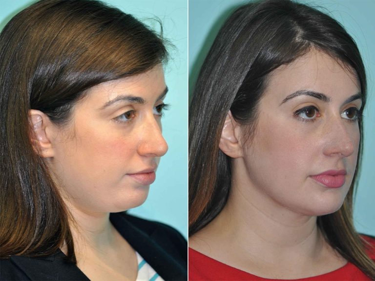 Everything You Need to Know About Submental Liposuction: Benefits and Recovery