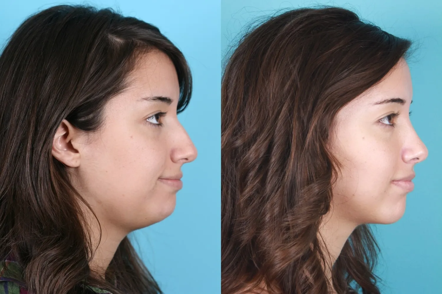 submental liposuction submental liposuction