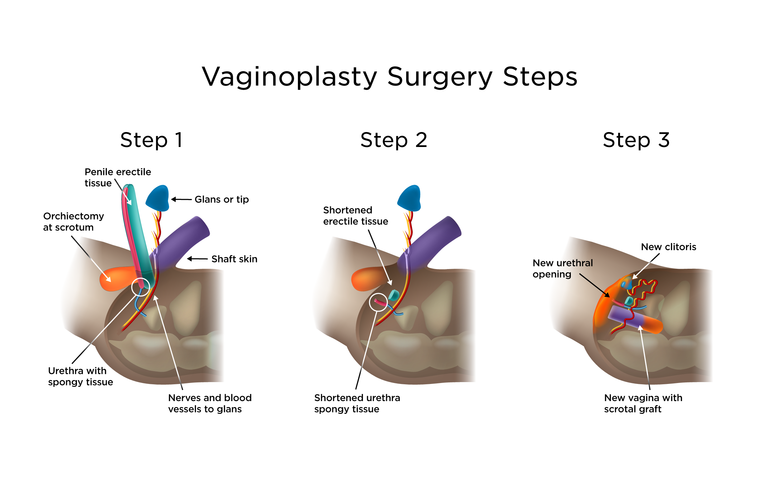 vaginal plastic surgery vaginal plastic surgery