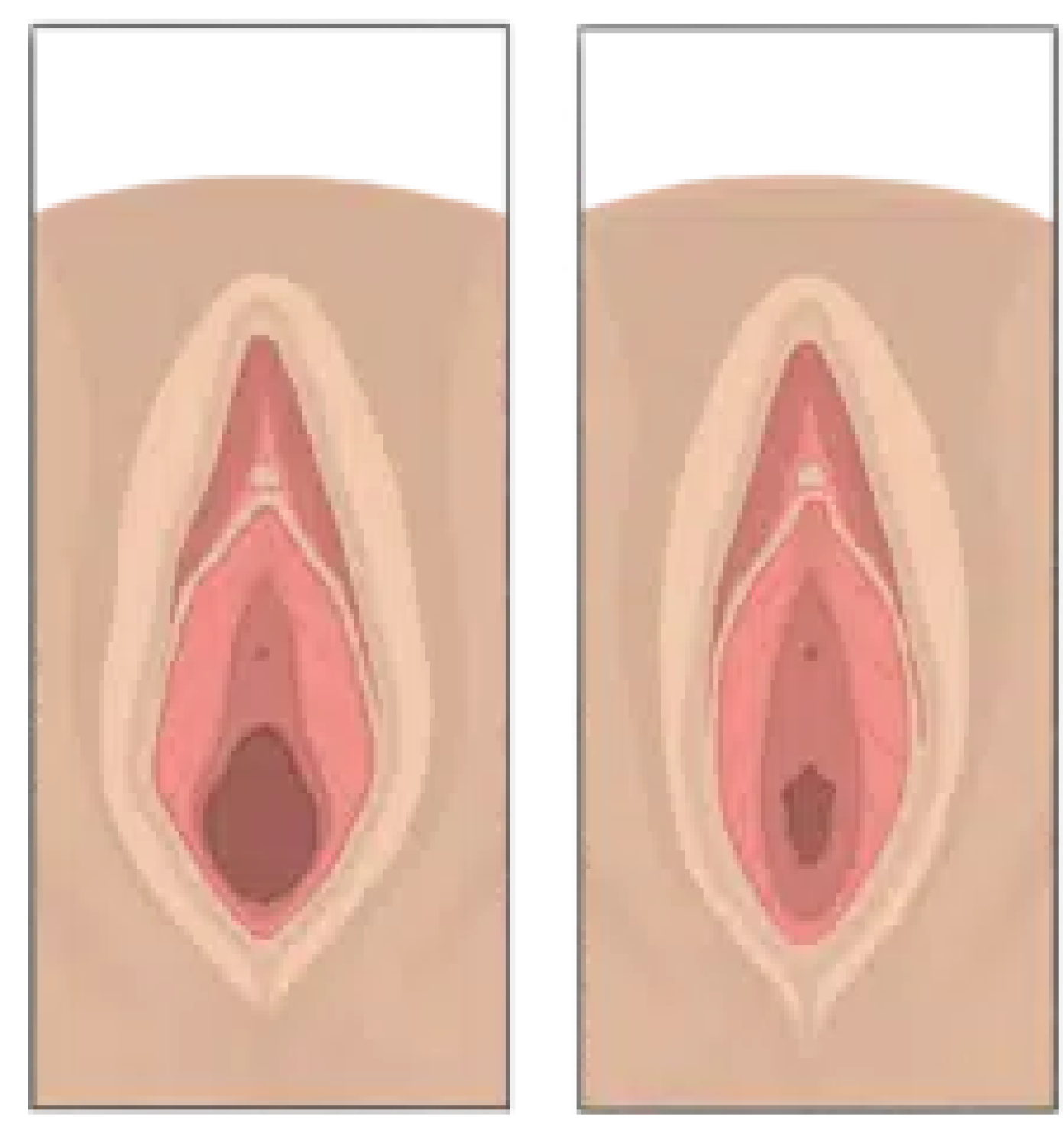 vaginal plastic surgery vaginal plastic surgery
