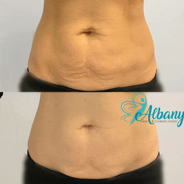 non surgical tummy tuck non surgical tummy tuck