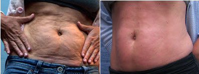 non surgical tummy tuck non surgical tummy tuck