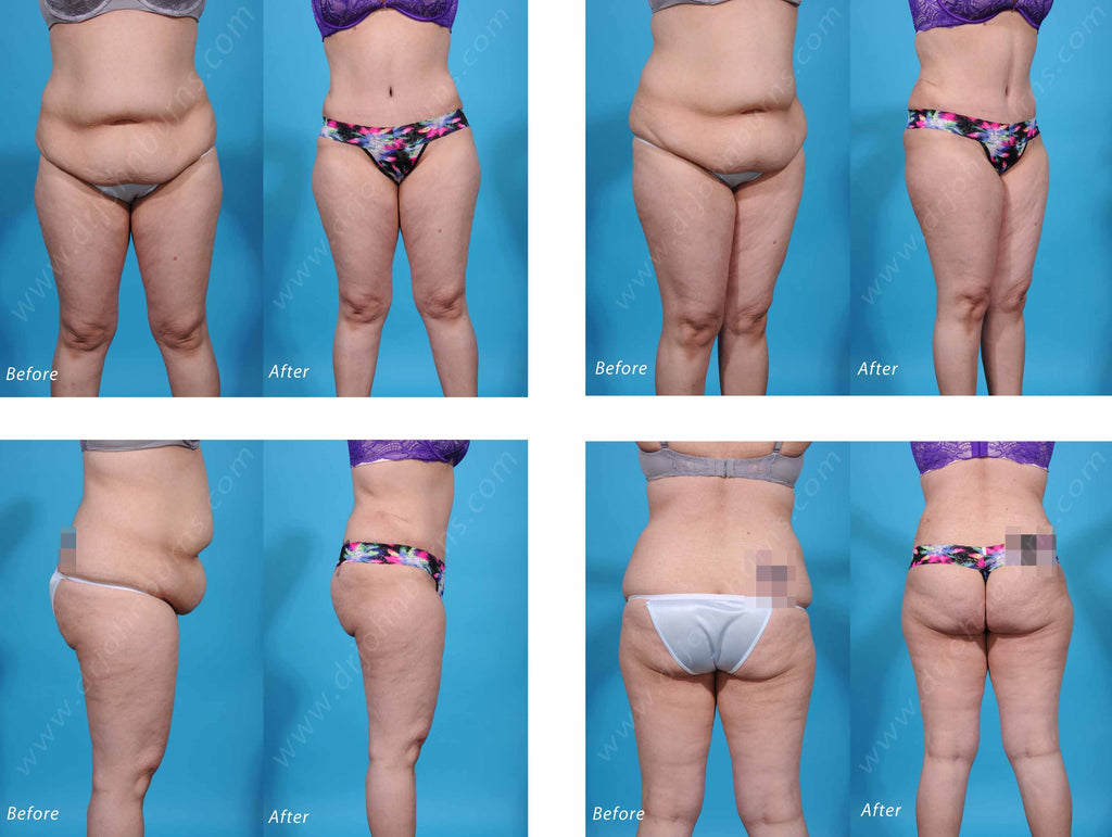 extended tummy tuck extended tummy tuck