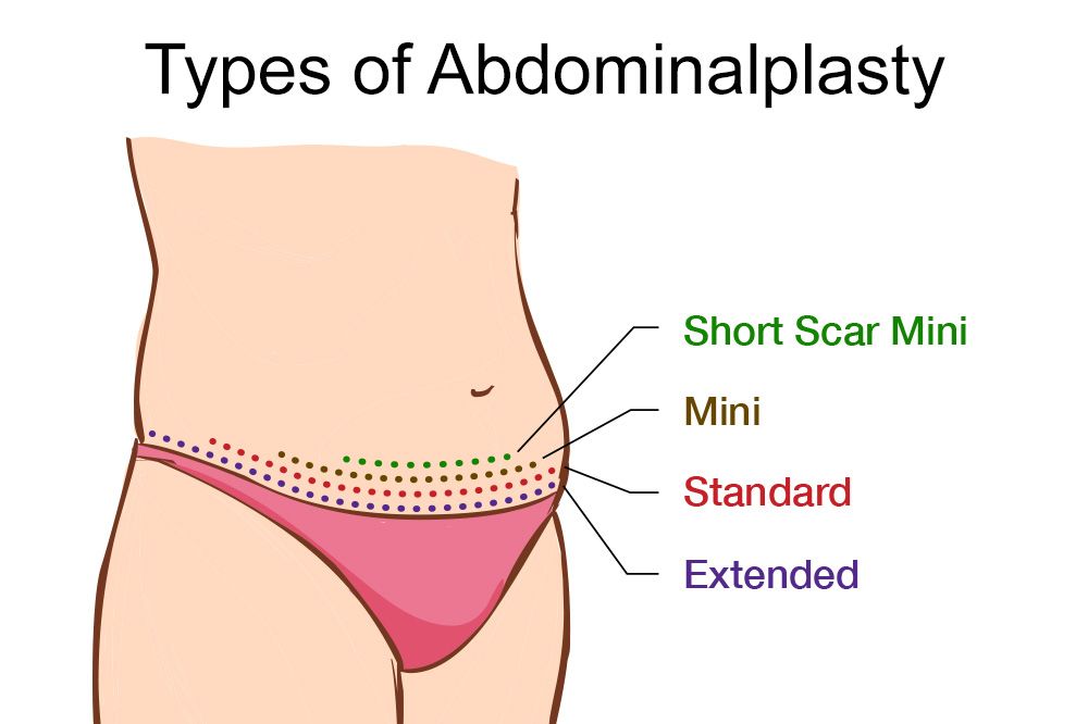 extended tummy tuck extended tummy tuck