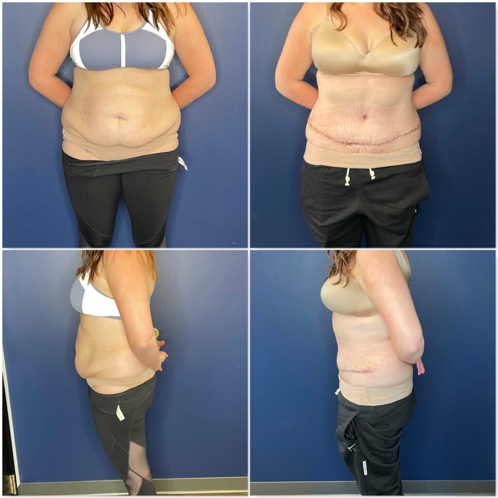 extended tummy tuck extended tummy tuck
