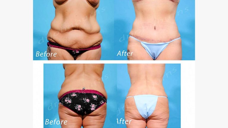 Extended Tummy Tuck: Comprehensive contouring
