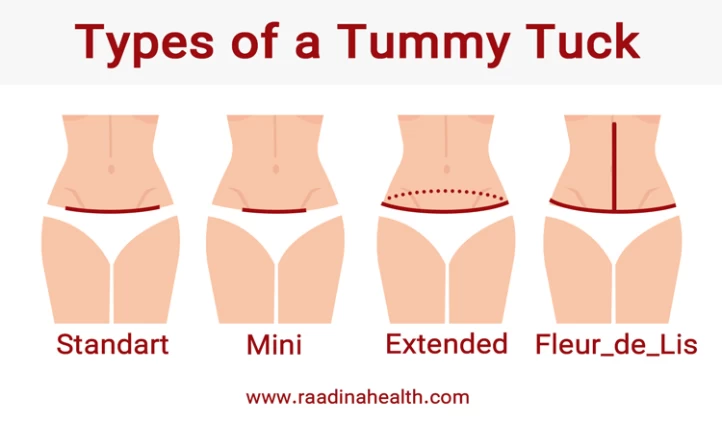 extended tummy tuck extended tummy tuck