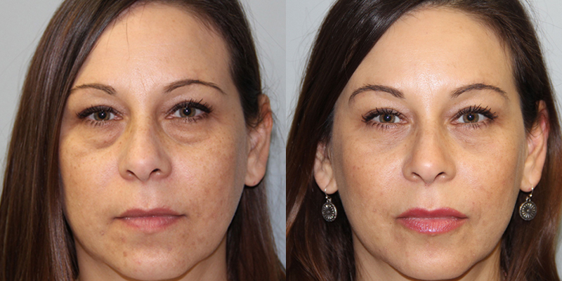 eye plastic surgery