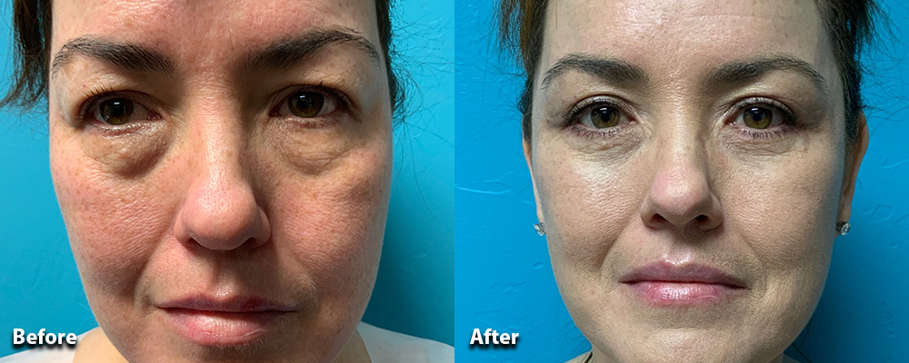 eye plastic surgery