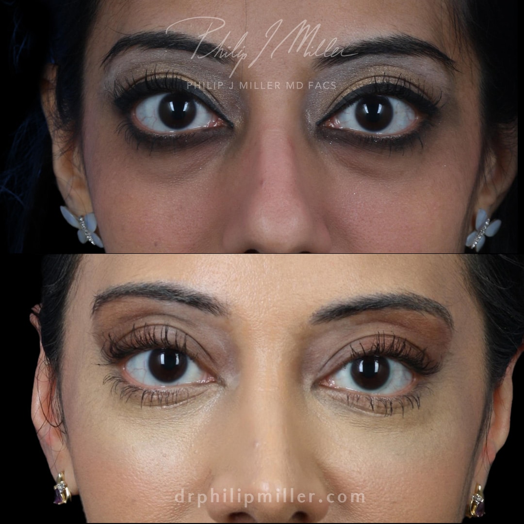 eye plastic surgery