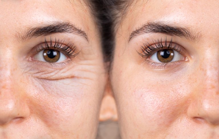 Eye plastic surgery: Procedures to brighten and rejuvenate