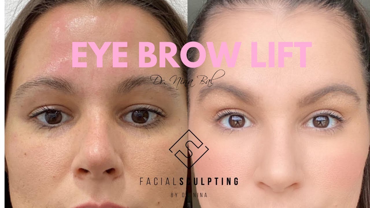 eyebrow lift eyebrow lift