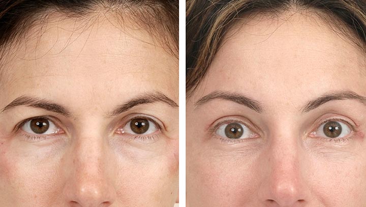 Eyebrow lift surgery: Enhancing your look with subtle changes