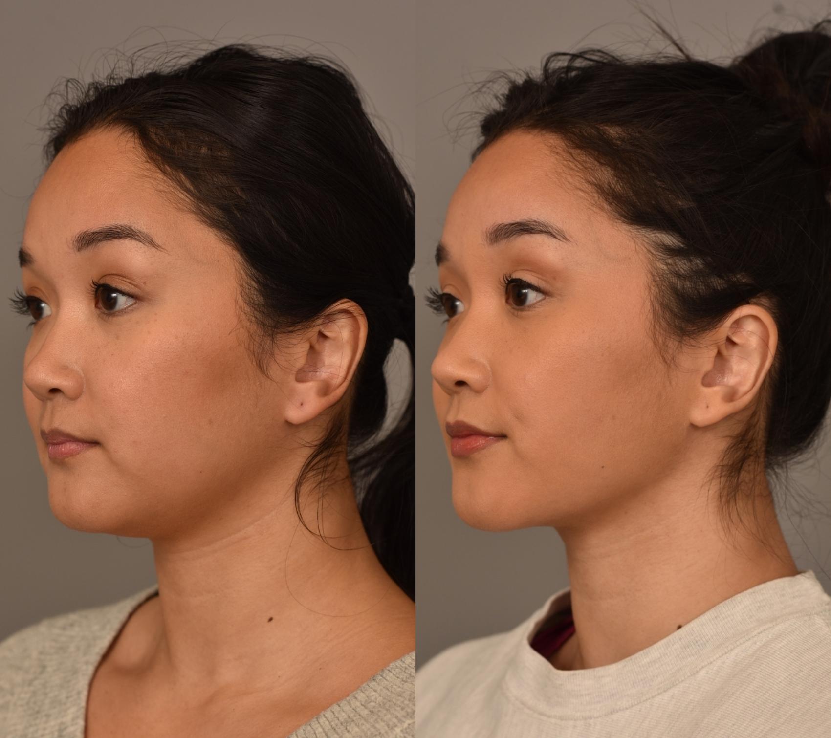face fat removal face fat removal
