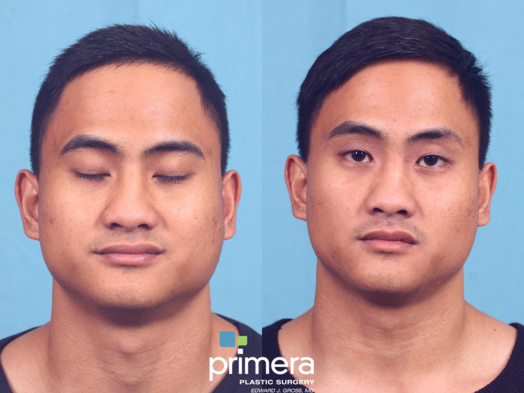 face fat removal face fat removal