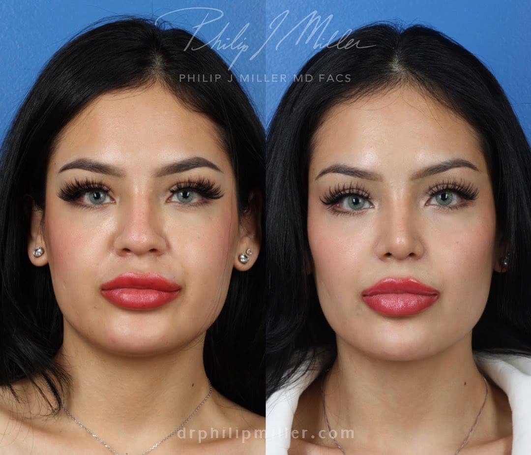 face fat removal face fat removal