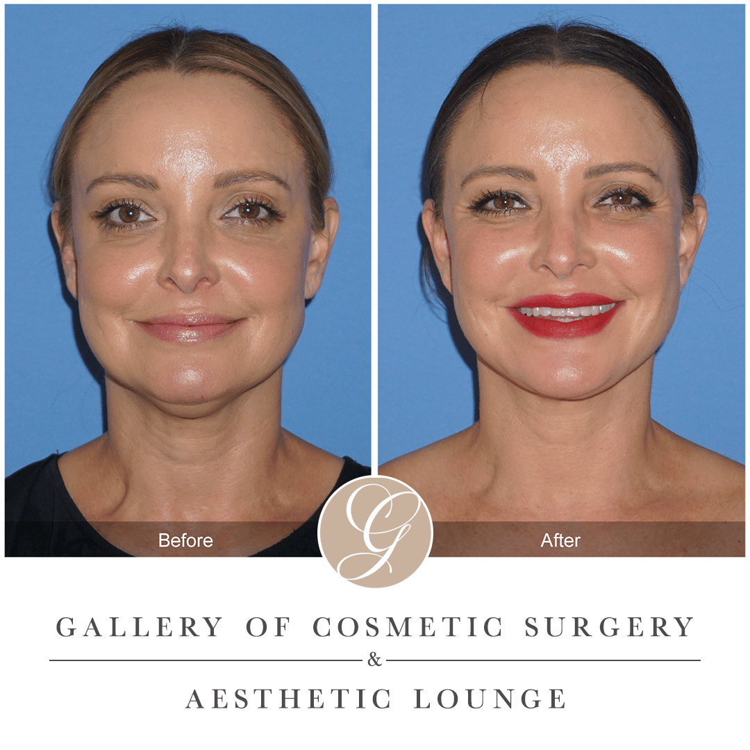 face fat removal face fat removal