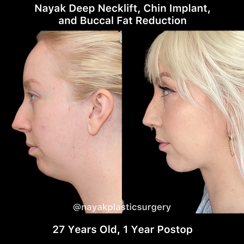 face fat removal surgery face fat removal surgery