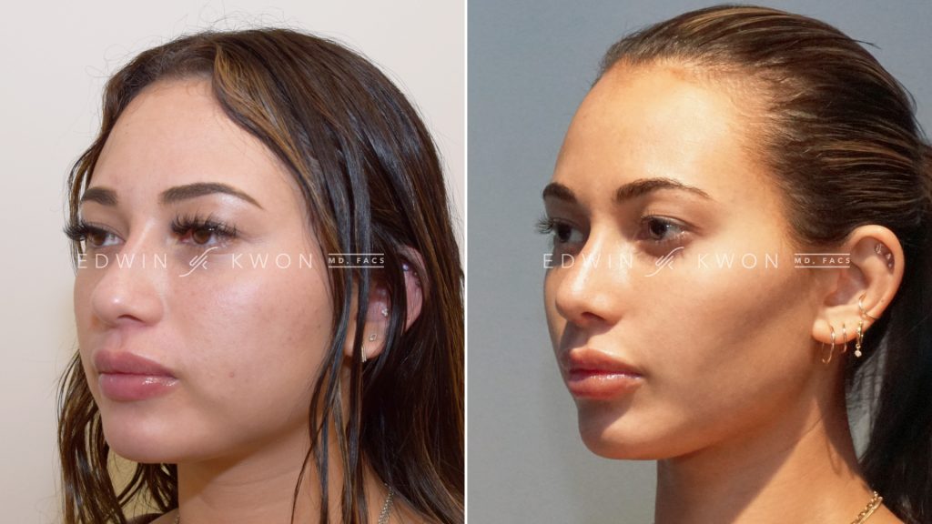 face fat removal surgery face fat removal surgery