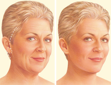 face lift treatment face lift treatment