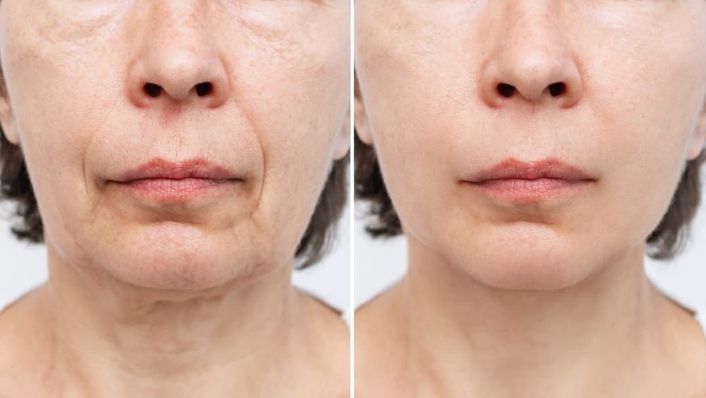 face lift treatment face lift treatment