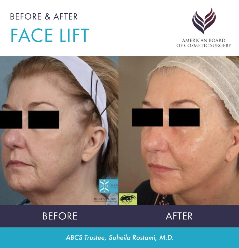 face lift treatment face lift treatment