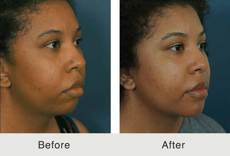 face liposuction face liposuction