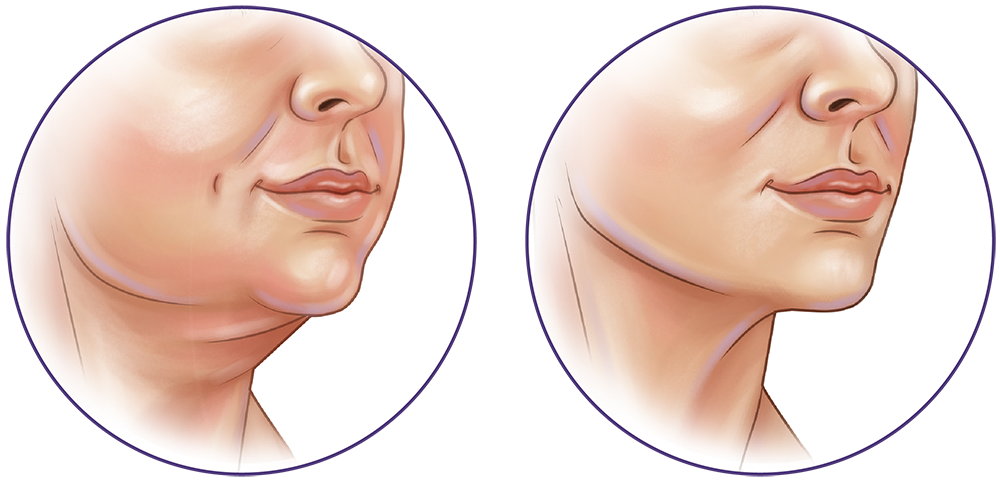 face liposuction face liposuction