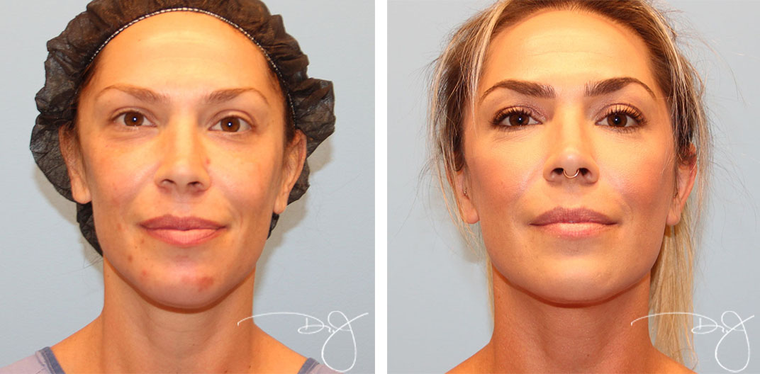 face liposuction face liposuction