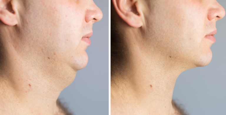 Face Liposuction: Sculpting youthful contours
