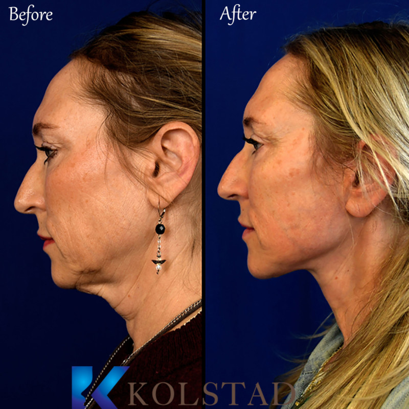 face plastic surgery cost face plastic surgery cost