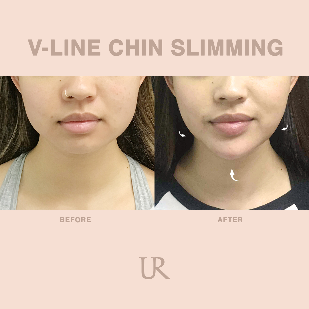face slimming surgery face slimming surgery