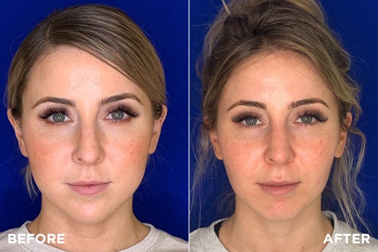 Face slimming surgery: Contouring for a sleeker look