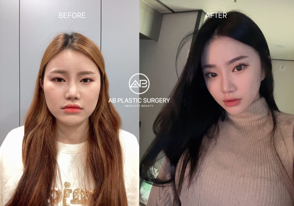 face slimming surgery face slimming surgery