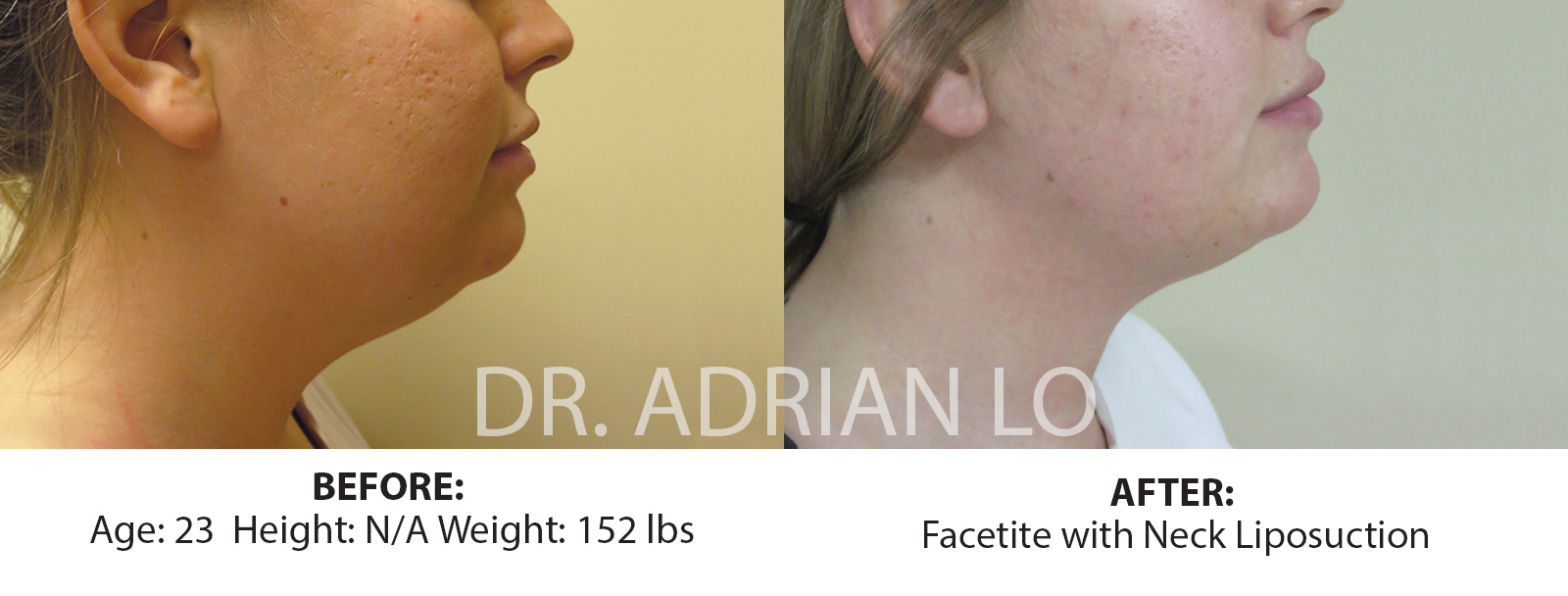 facetite cost facetite cost