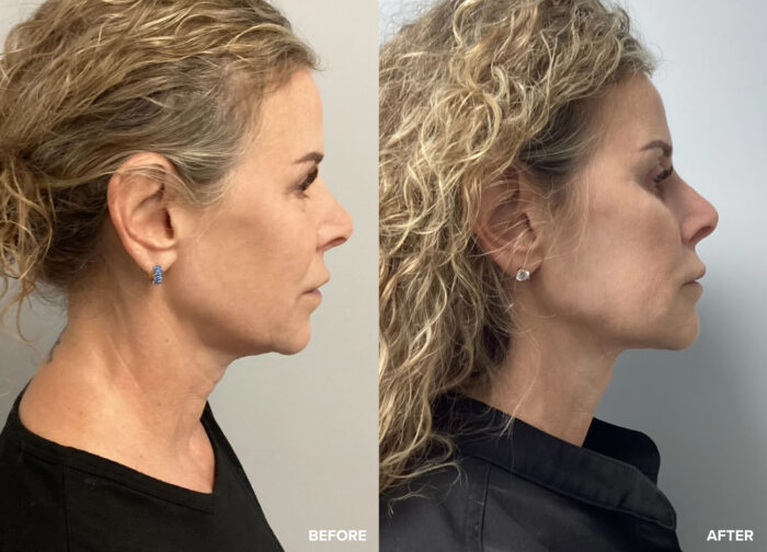 FaceTite cost: Contouring and tightening made simple