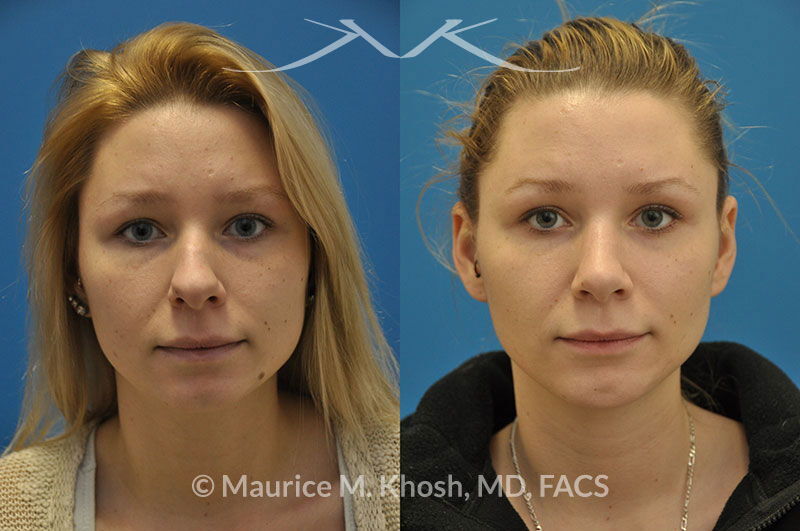 facial implants facial implants