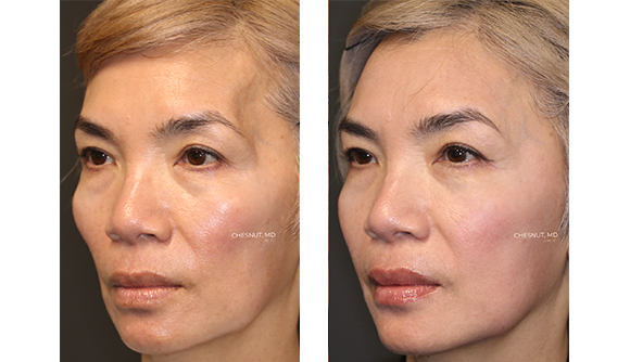 facial implants facial implants