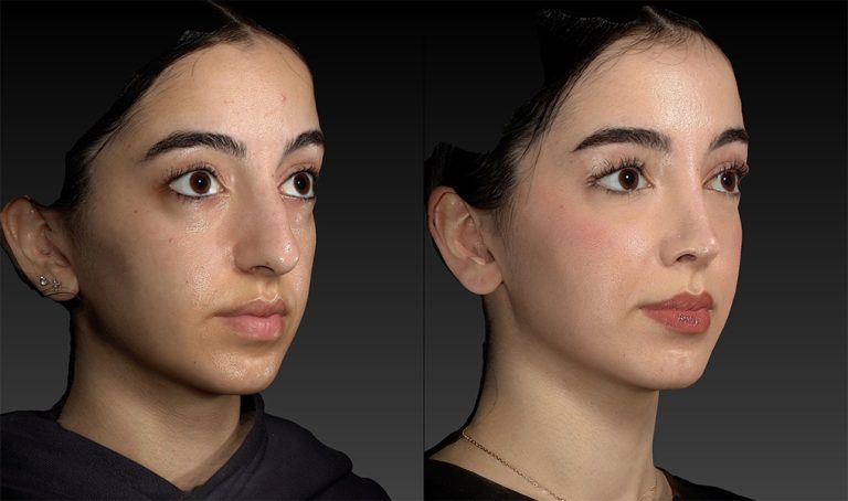 Facial implants: Enhancing structure and balance