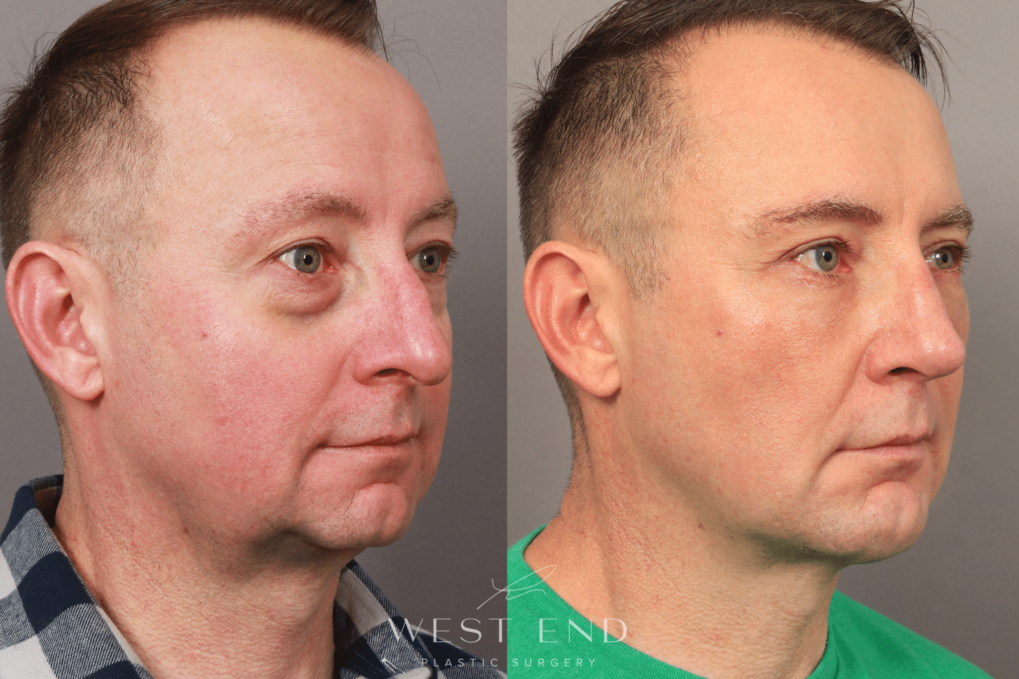 facial implants facial implants